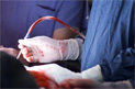 Chicago Breast Implants Implant Surgery